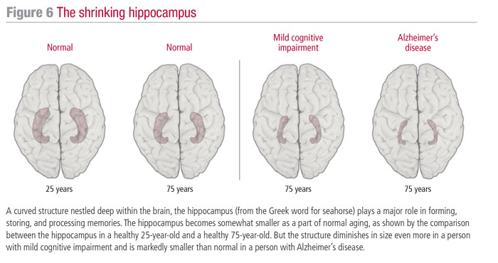 the-shrinking-hippocampus-700