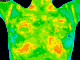 Thermography of breasts - 6/21/18 Pre rubbing frankincense oil on breasts.