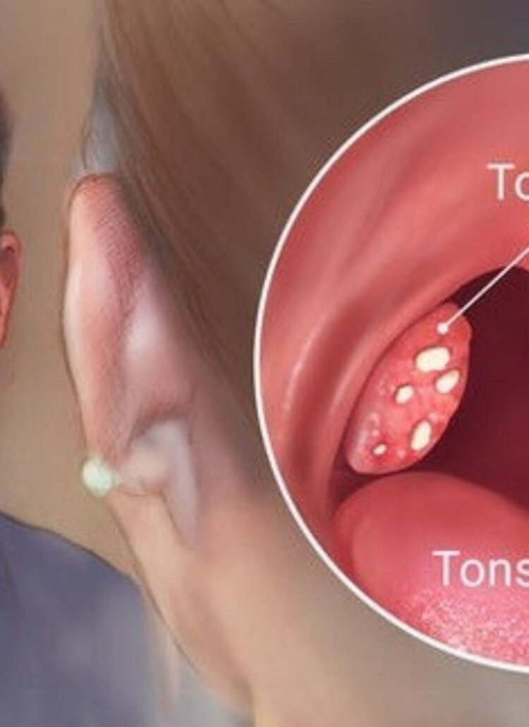 diary causes tonsil stones