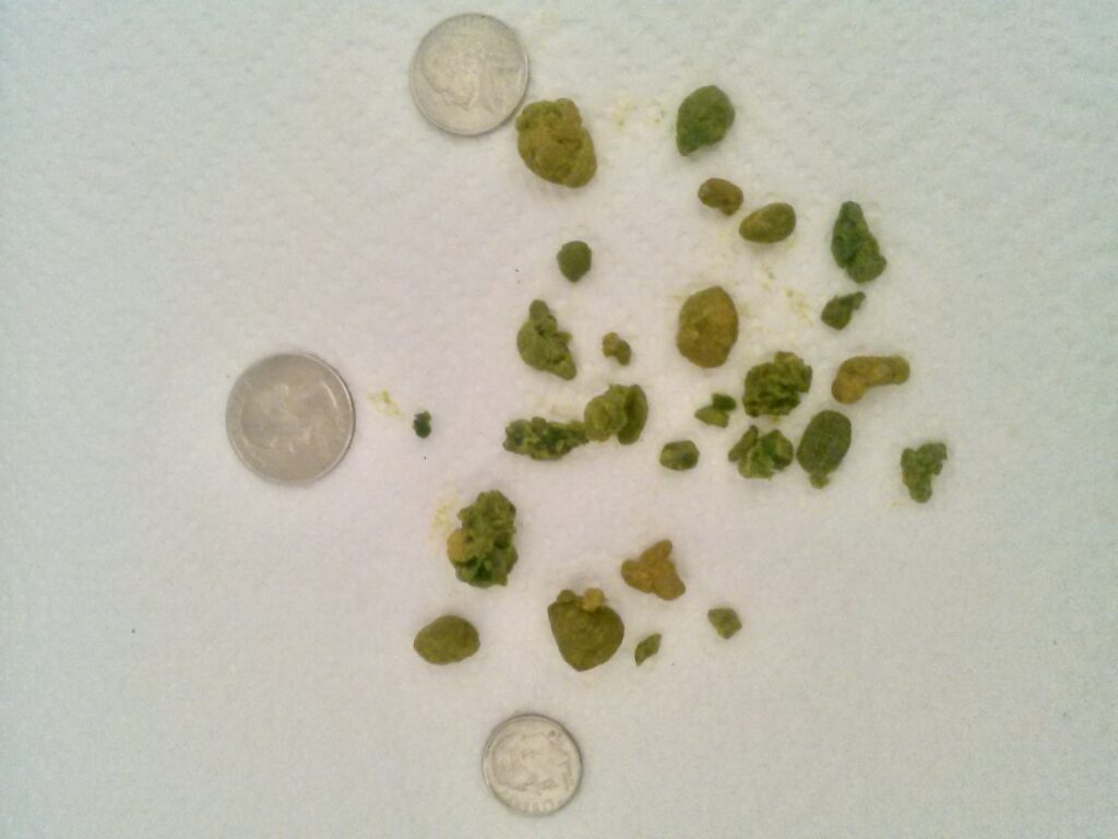 An image showing gallbladder stones in this blog post about Effects Of Gallbladder Removal